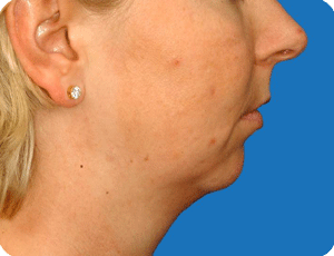 Weak chin, compensated orthodontic occlusion, obtuse nasolabial angle, unsupported cheek tissues, obtuse chin-neck angle