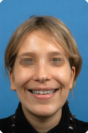 After upper jaw & chin reduction, rhinoplasty and liposculpture