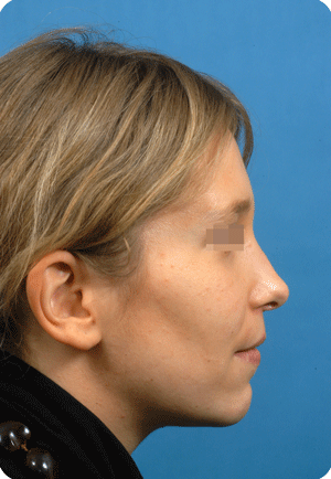 After upper jaw & chin reduction, rhinoplasty and liposculpture