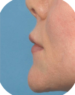 After lower lip augmentation with hyaluronic acid