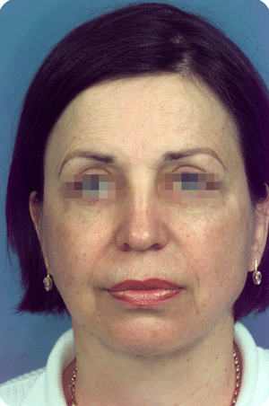 Aftar face and neck lift, and 4 eyelids
