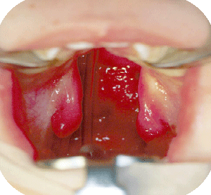 Isolated cleft palate (P1)