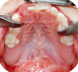 View on hard palate after repair