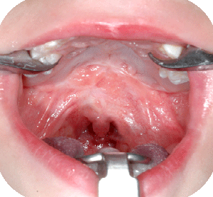 View on soft palate after Furlow repair