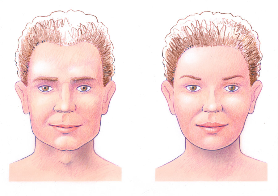 Monsplasty: The Unspoken & Often Forgotten Procedure - Visage Cosmetic  Plastic Surgery