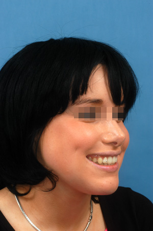 After TPD, bimax and nose correction