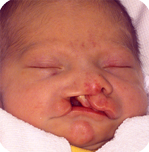 Bilateral cleft lip & palate, right side full blown, left side microform