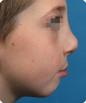 Nasal projection needs correction at a later stage