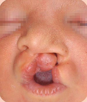 Left sided cleft lip