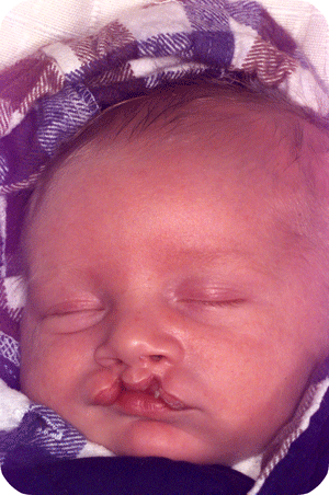 Bilateral incomplete cleft lip