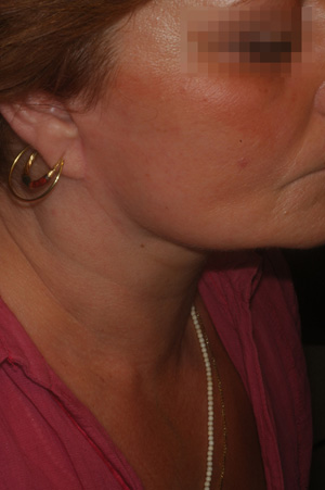 6 months after a Perfect Neck Lift and face lift