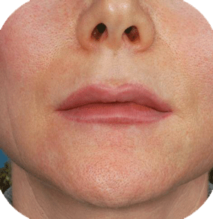 After lower lip augmentation with hyaluronic acid