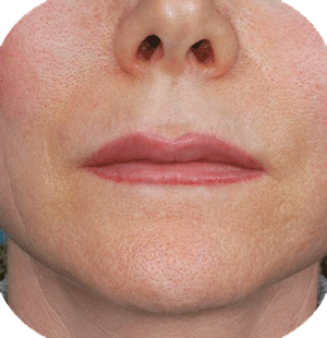 3 months after upper lip augmentation with hyaluronic acid