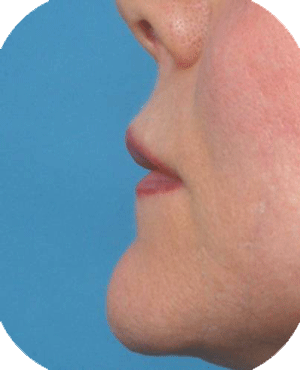 3 months after upper lip augmentation with hyaluronic acid