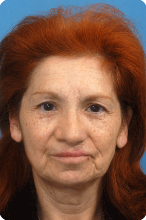 After nose and lip correction
