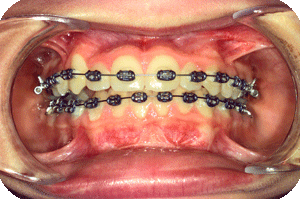 Further orthodontic alignement