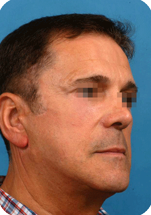 After rhinoplasty,face & neck lift, 4 eyelids, forehead lift, hair restoration and complementary fat transplantation