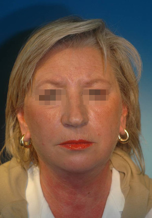 6 months after a Perfect Neck lift and face lift